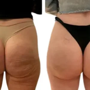 Injections Fessières PMMA 2000cc